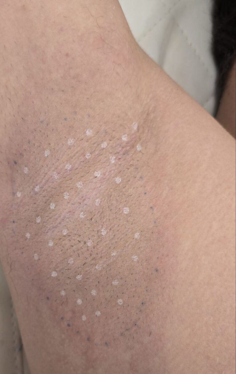 Toxina Botulínica de axilas