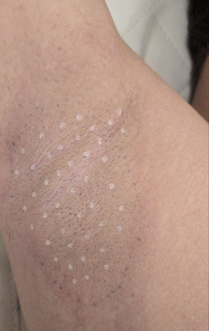 Toxina Botulínica de axilas